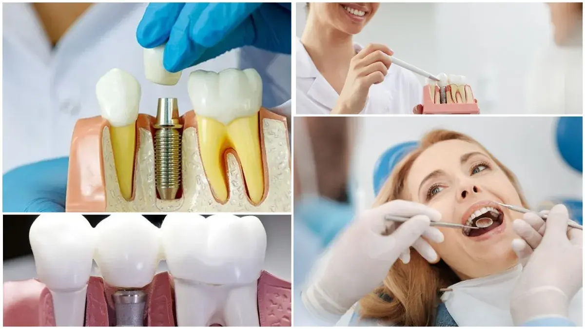 імплантація зубів