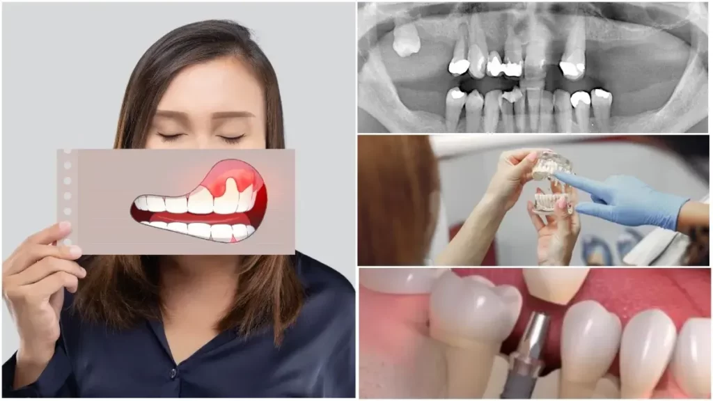 Імплантація зубів при парадонтозі: важливі аспекти та процедури