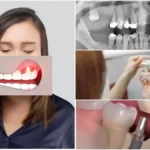 імплантації зубів при парадонтозі